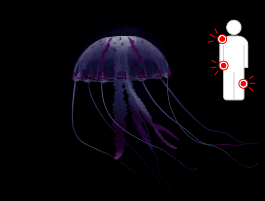 Что делать, если ужалила медуза в море: первая помощь